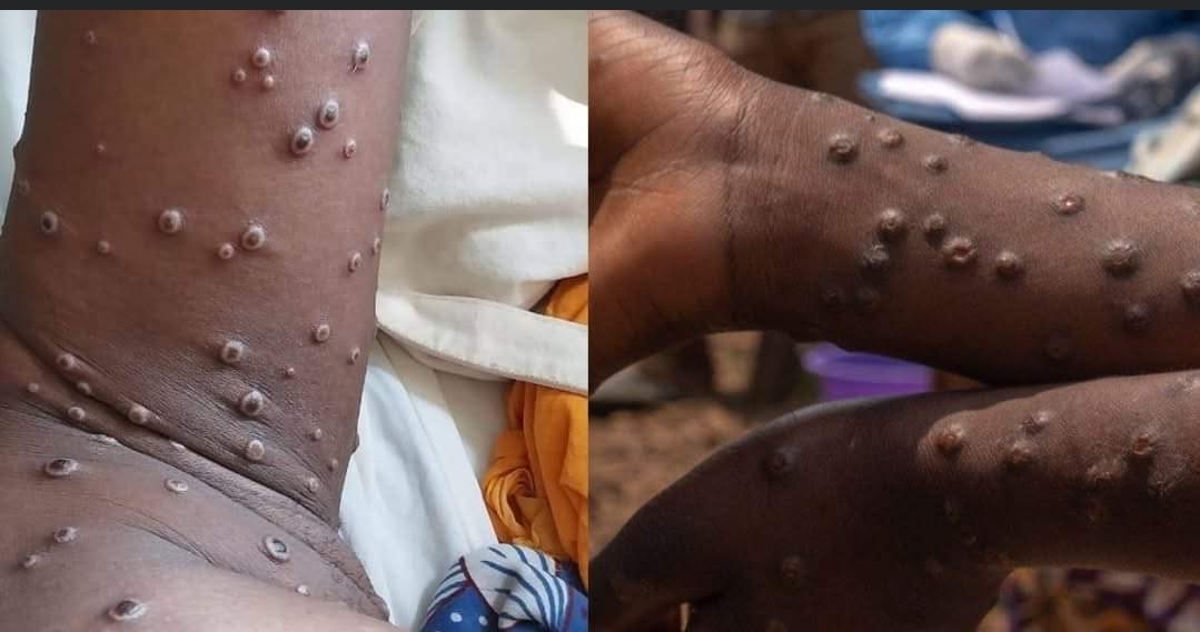 BREAKING: Mpox Outbreak Reported in Lugari, Kakamega — Health Alert Issued